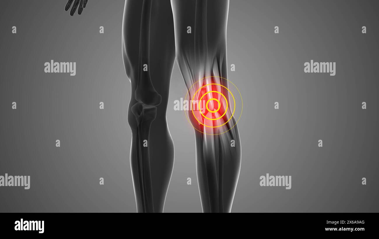 Kniebeschwerden, die Schmerzen auslösen Stockfoto