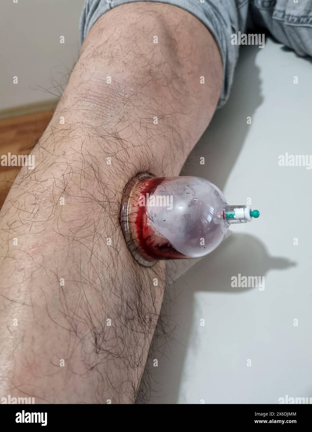 Die Blutegeltherapie an den Beinen ist eine Methode, die in der traditionellen Medizin angewendet wird. Stockfoto