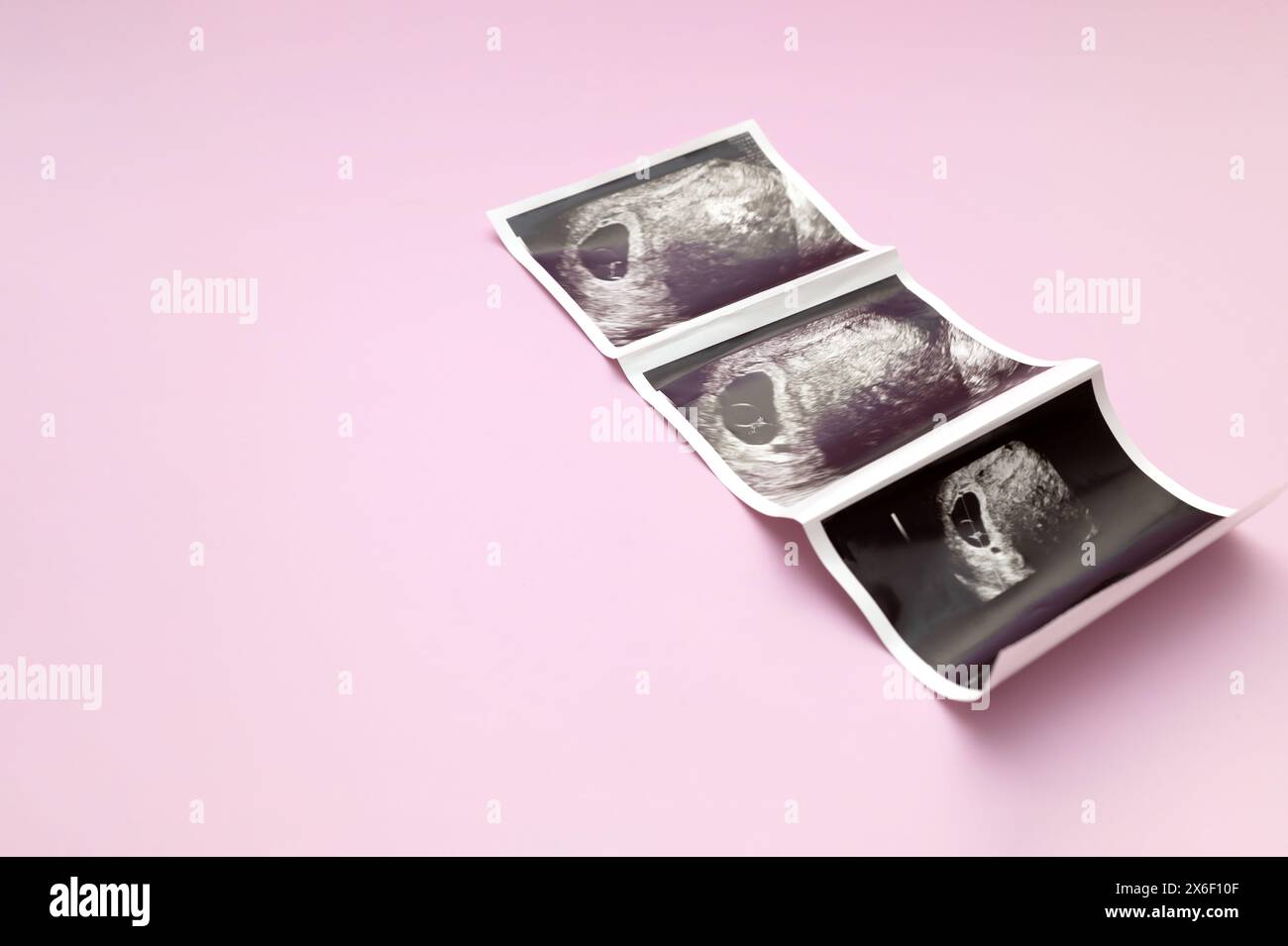 Ultraschallbild, Bild Von 7 Wochen Schwangere Frau Mit Zwillingen, Embryo Auf Rosa Hintergrund. Selektiver Fokus. Platz Für Text, Modell. Fetusentwicklung Stockfoto