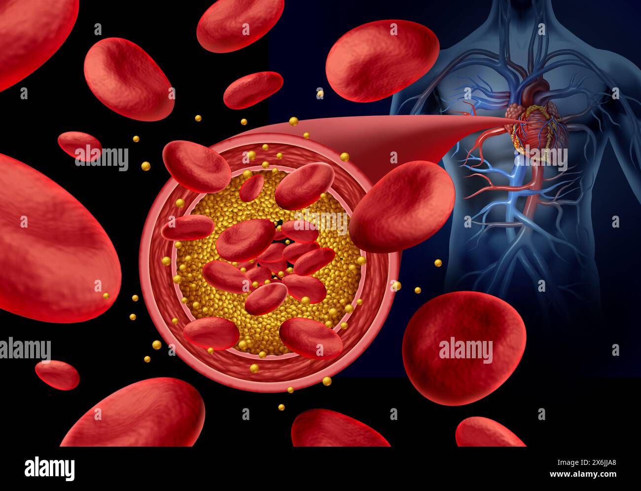Atherosklerose Arterienplaque und verstopfte Arterien Krankheit medizinisches Konzept mit Blutzellen, die durch Anhäufung von Cholesterin als Symbol blockiert wird Stockfoto