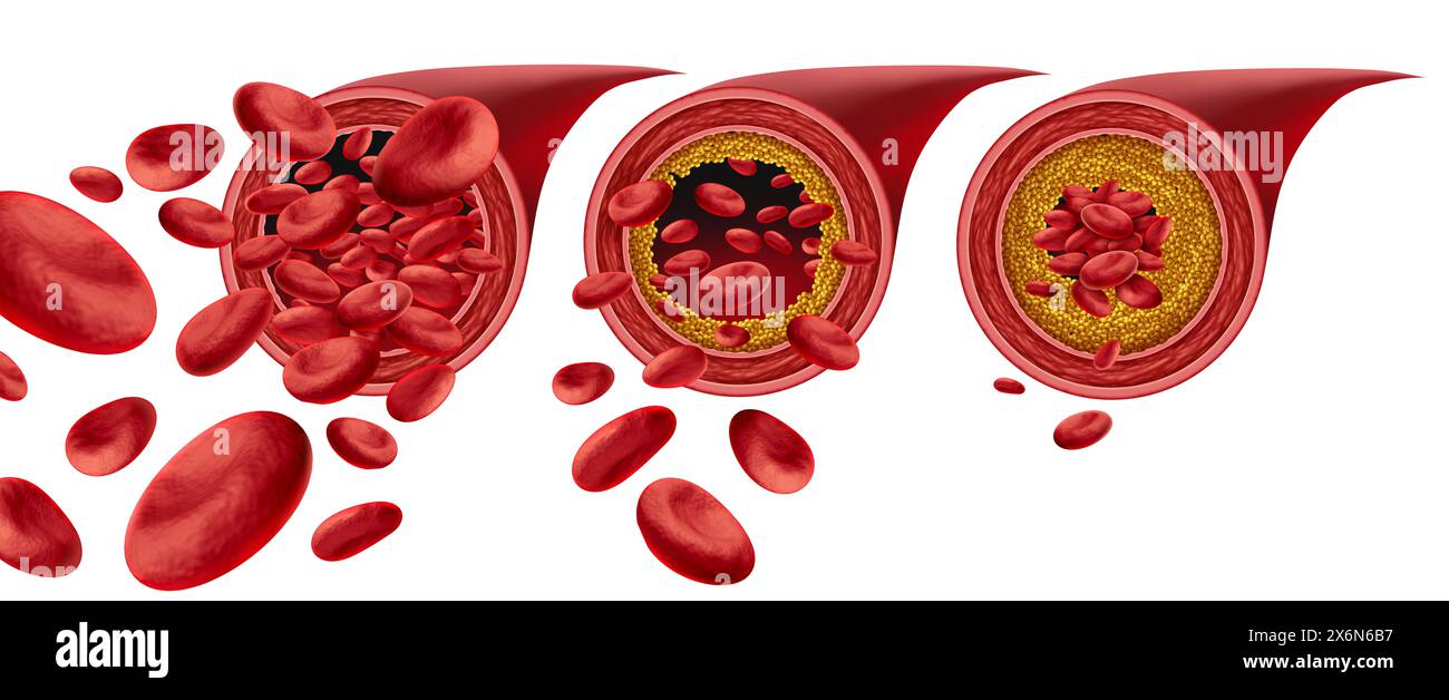 Atherosklerose Plaquebildung und verstopfte Arterien Krankheit medizinisches Konzept mit Blutzellen, die durch Anhäufung von Cholesterin als Symbol o blockiert werden Stockfoto