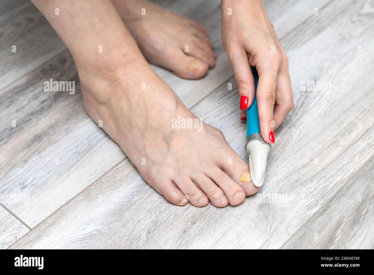 Eine Frau schleift ihre Zehennägel mit einem Schleifgerät. Nagelpilz. Zehennagel-Krankheit. Frau, die sich um die Zehennägel kümmert. Gelber Zehennagel. Elektrischer Nagelschleifer. Fürsorglich f Stockfoto