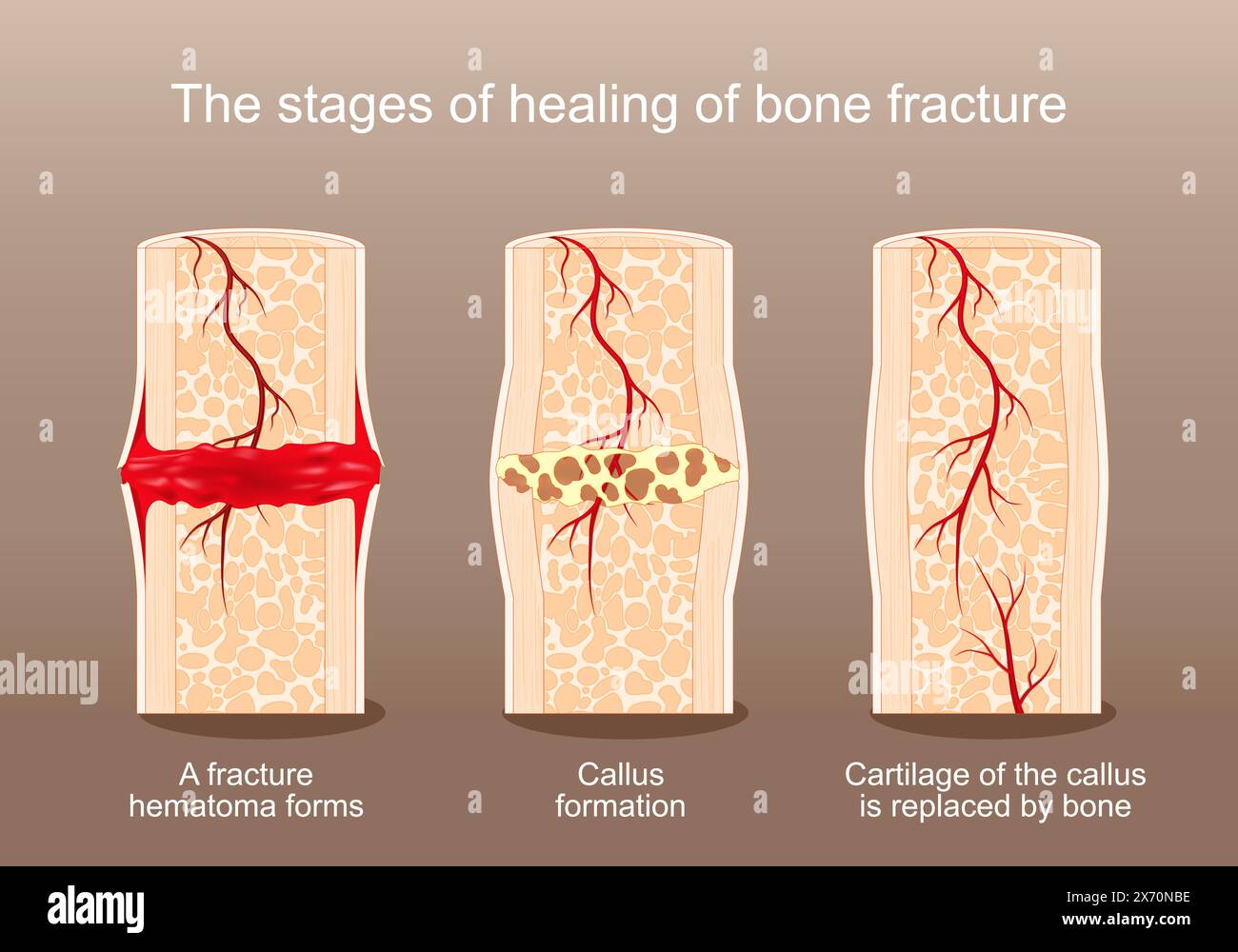 Die Stadien der Heilung der Knochenfraktur. Vom Hämatom und Kallus zum Knorpel, der durch Knochen ersetzt wird. Vektorposter. Abbildung „Isometrische Abwicklung“ Stock Vektor