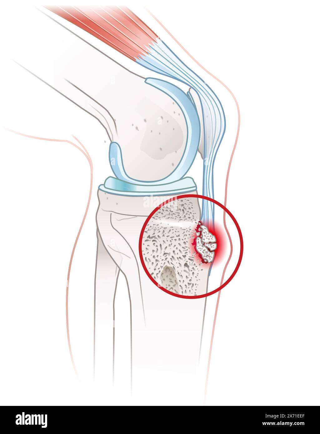 Morbus Osgood-Schlatter verursacht Knieschmerzen und Schwellungen an der Tuberosität der Unterschenkel, häufig bei Jugendlichen aufgrund des schnellen Wachstums und der körperlichen Aktivität. Stockfoto