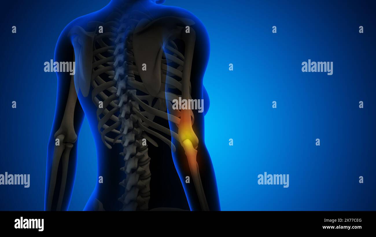 Frau mit Ellbogenschmerzen Stockfoto