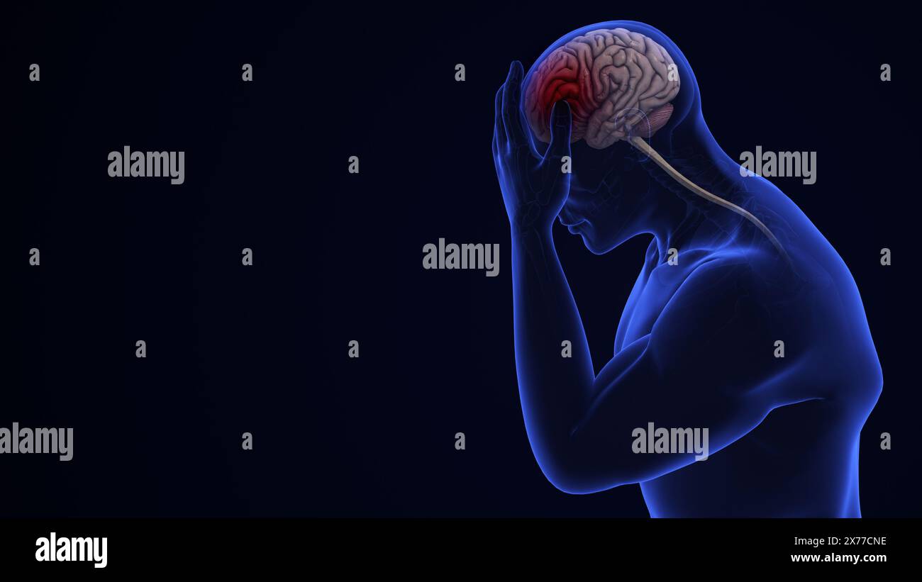 Menschliche Hirnblutungskranke Stockfoto