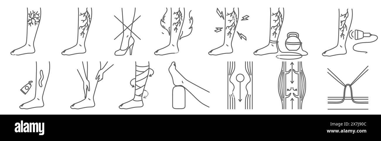 Krampfaderkrankheit Symptom, behandlungsmedizinische Infografik Stock Vektor