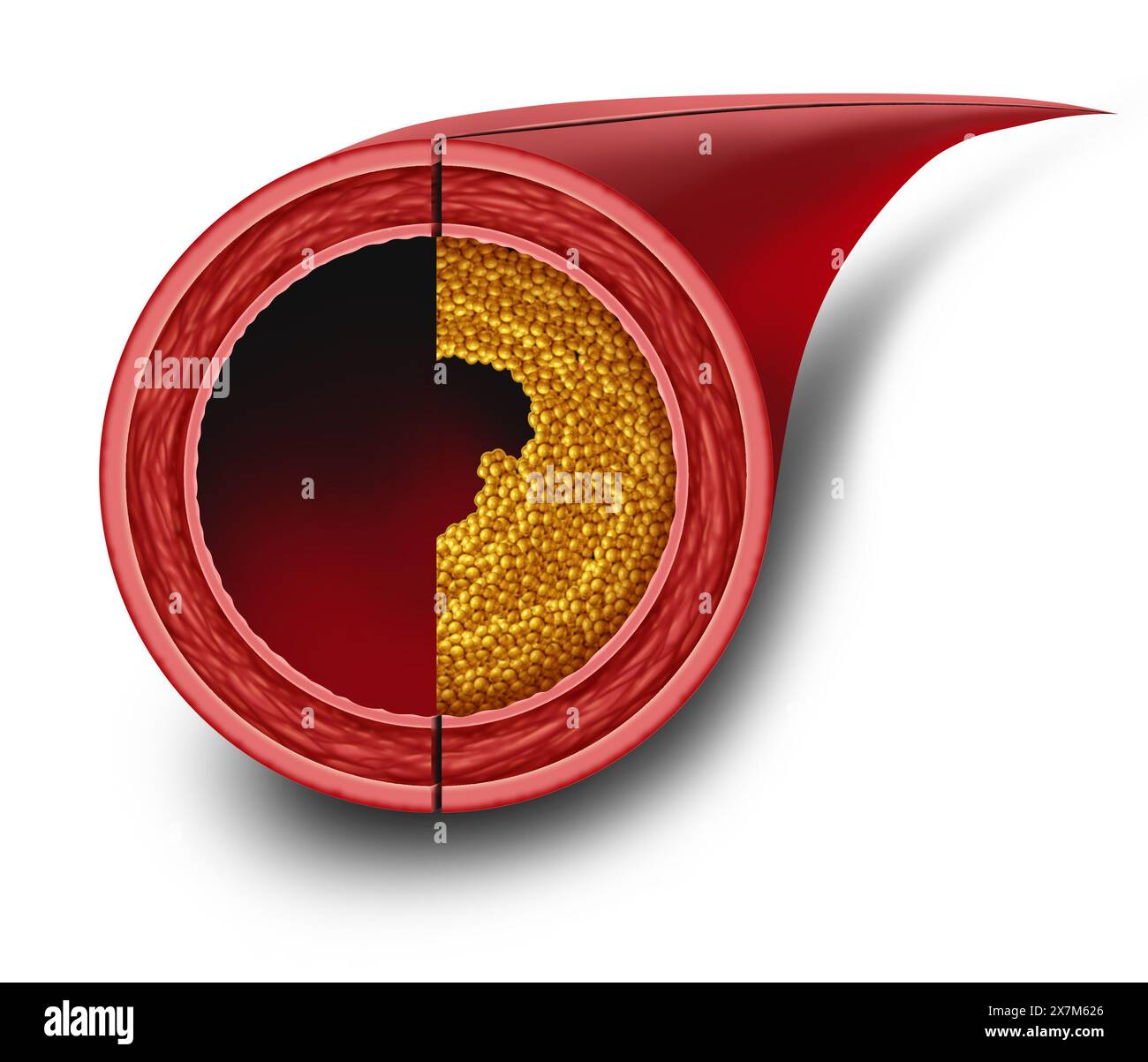Normale Arterien und Arteriosklerose als Plaquebildung und verstopfte Arterien Krankheitsbild blockiert durch Cholesterinanreicherung als Symbol für AR Stockfoto