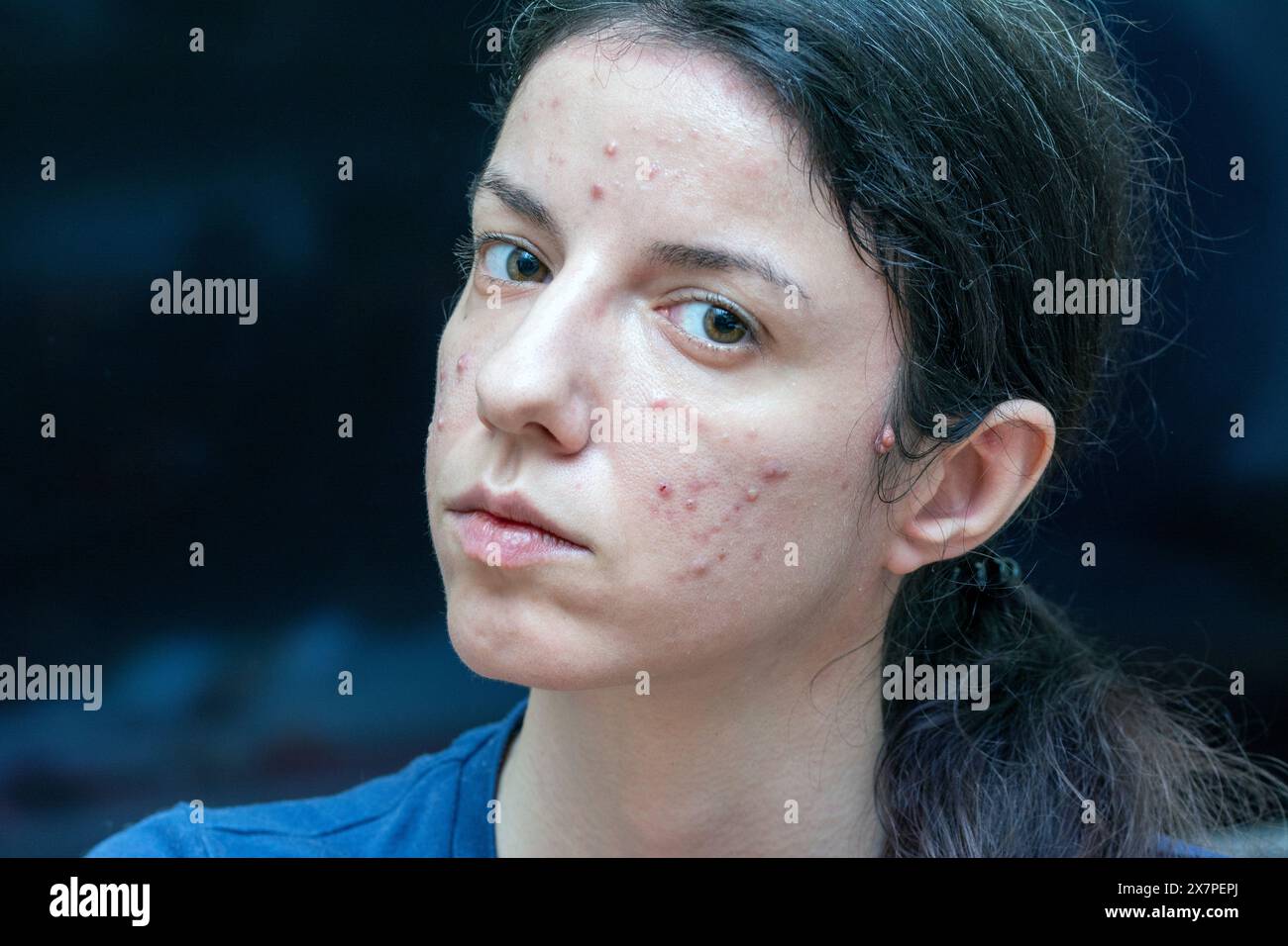 Kaukasische Frau mit zystischer Akne aus verstopften Poren und fettiger Haut Stockfoto