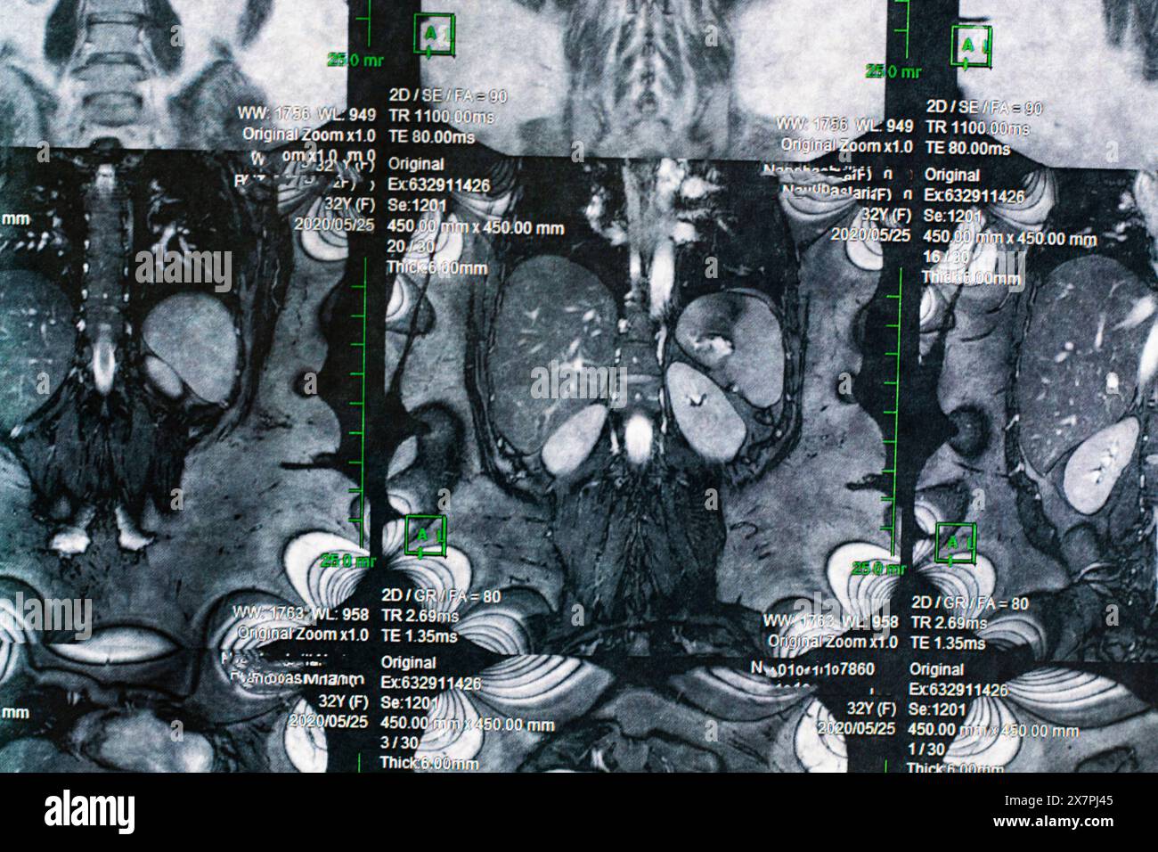Magnetcomputertomographisches Foto von Frauen Stockfoto