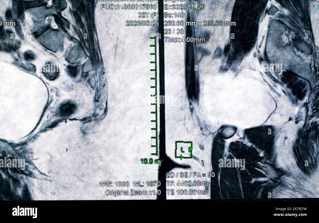 Magnetcomputertomographisches Foto von Frauen Stockfoto