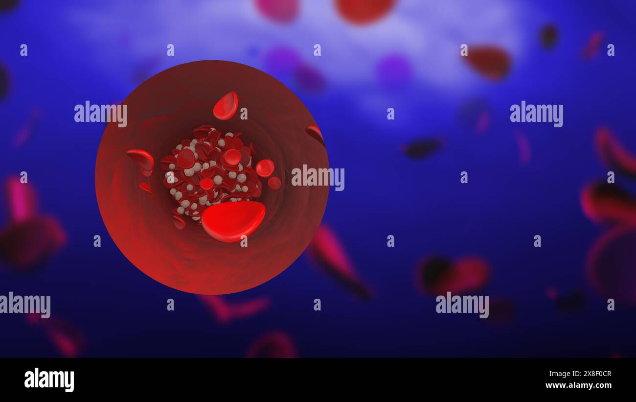 Medizinisches Konzept des Blutgerinnsels der menschlichen Arterien Stockfoto