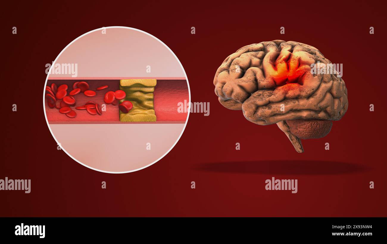 Periphere Neuropathien können Schmerzen verursachen. Stockfoto