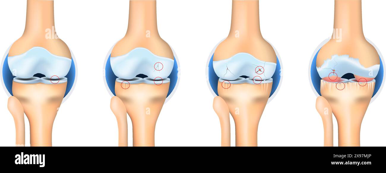 Stadien der Arthrose. Anatomie des Kniegelenks Vektor-Illustration Stock Vektor