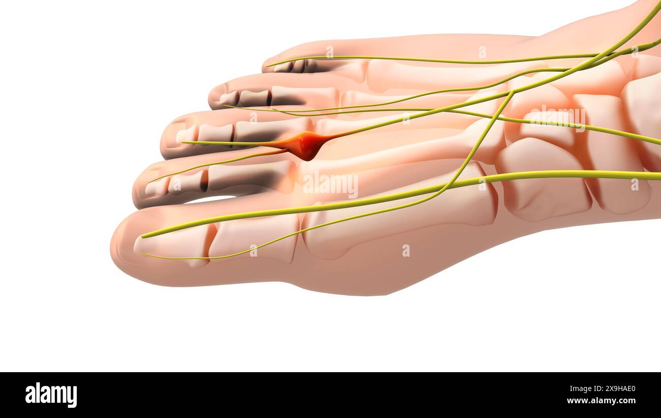Ein schmerzhaftes Neurom oder eingeklemmter Nerv im Fuß Stockfoto