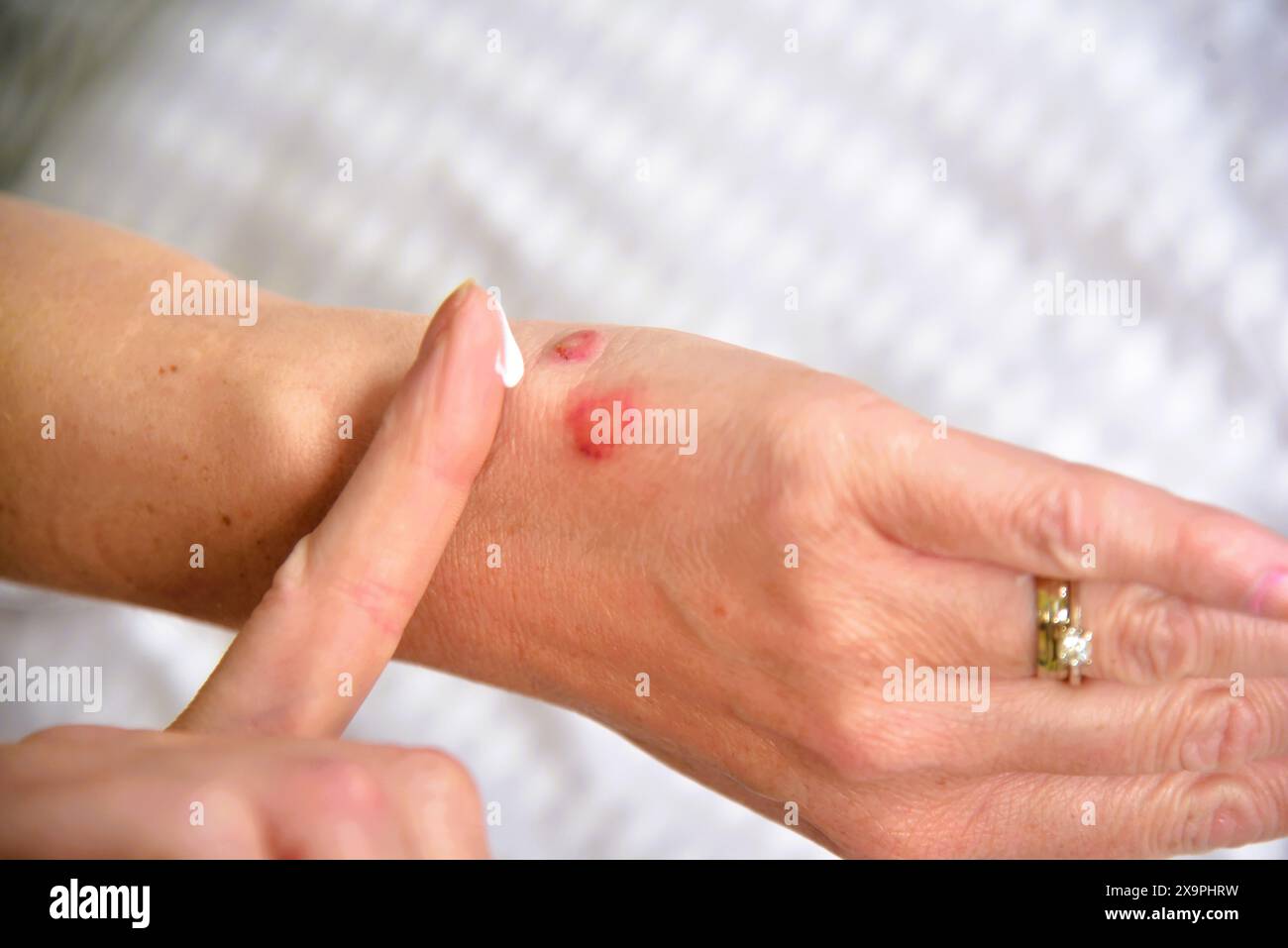 Bilder zeigen einen Patienten, der behandelt wird, nachdem er Mückenstiche während eines Urlaubs in Zante, Griechenland, im Mai 2024 erlitten hat Stockfoto