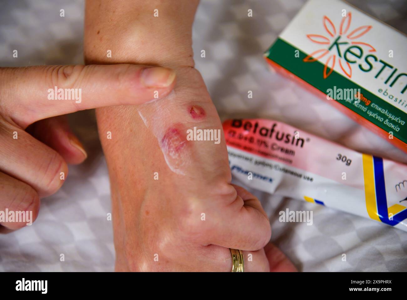 Bilder zeigen einen Patienten, der behandelt wird, nachdem er Mückenstiche während eines Urlaubs in Zante, Griechenland, im Mai 2024 erlitten hat Stockfoto