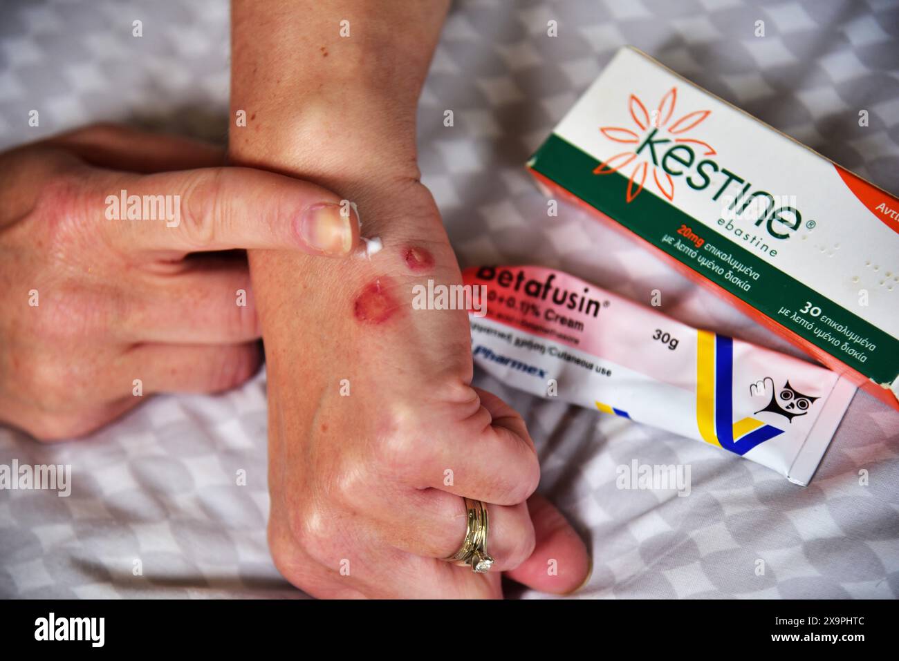 Bilder zeigen einen Patienten, der behandelt wird, nachdem er Mückenstiche während eines Urlaubs in Zante, Griechenland, im Mai 2024 erlitten hat Stockfoto