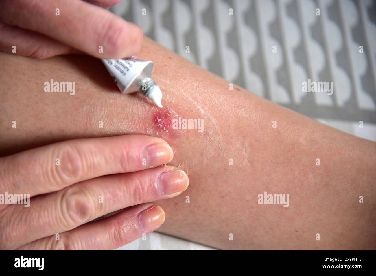 Bilder zeigen einen Patienten, der behandelt wird, nachdem er Mückenstiche während eines Urlaubs in Zante, Griechenland, im Mai 2024 erlitten hat Stockfoto