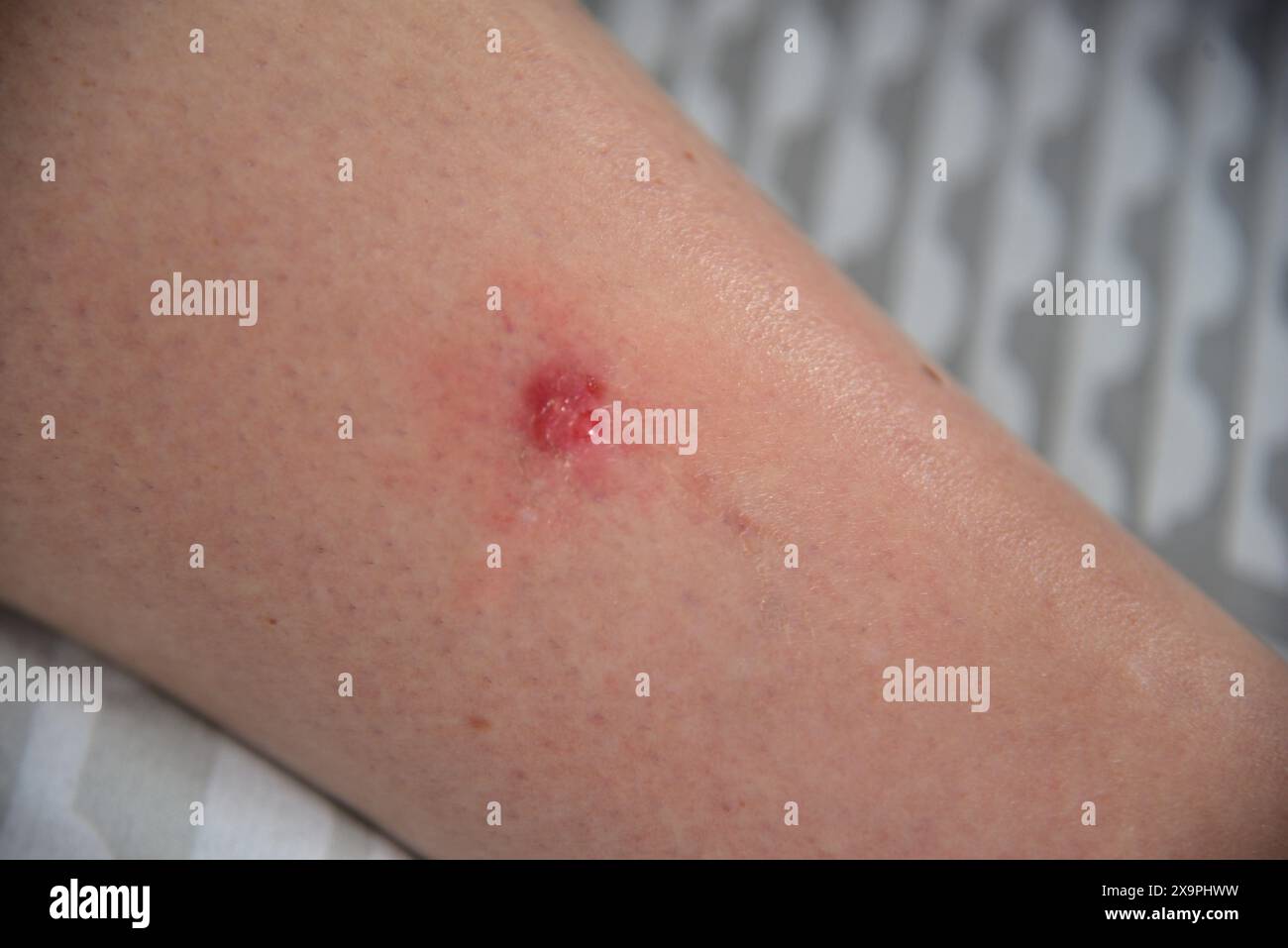 Bilder zeigen einen Patienten, der behandelt wird, nachdem er Mückenstiche während eines Urlaubs in Zante, Griechenland, im Mai 2024 erlitten hat Stockfoto