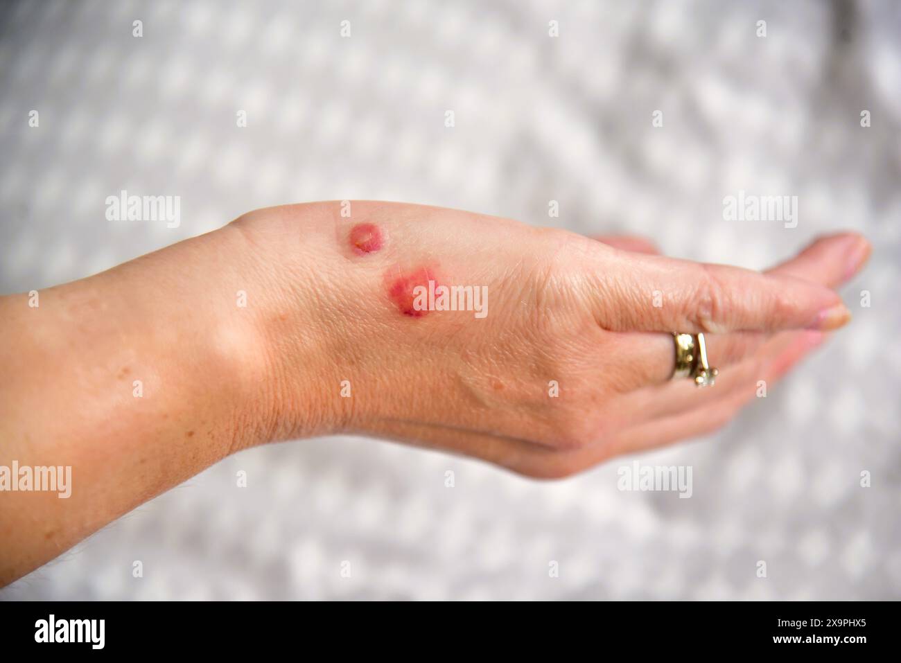 Bilder zeigen einen Patienten, der behandelt wird, nachdem er Mückenstiche während eines Urlaubs in Zante, Griechenland, im Mai 2024 erlitten hat Stockfoto