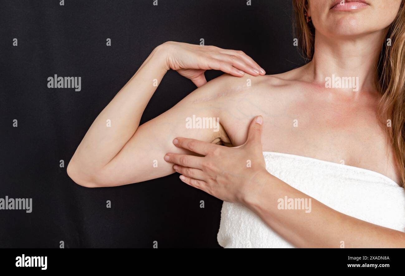 Postoperative Narbe auf der Schulter einer Frau. Geheilte Narbe nach Operation nach gebrochenem Armknochen Stockfoto