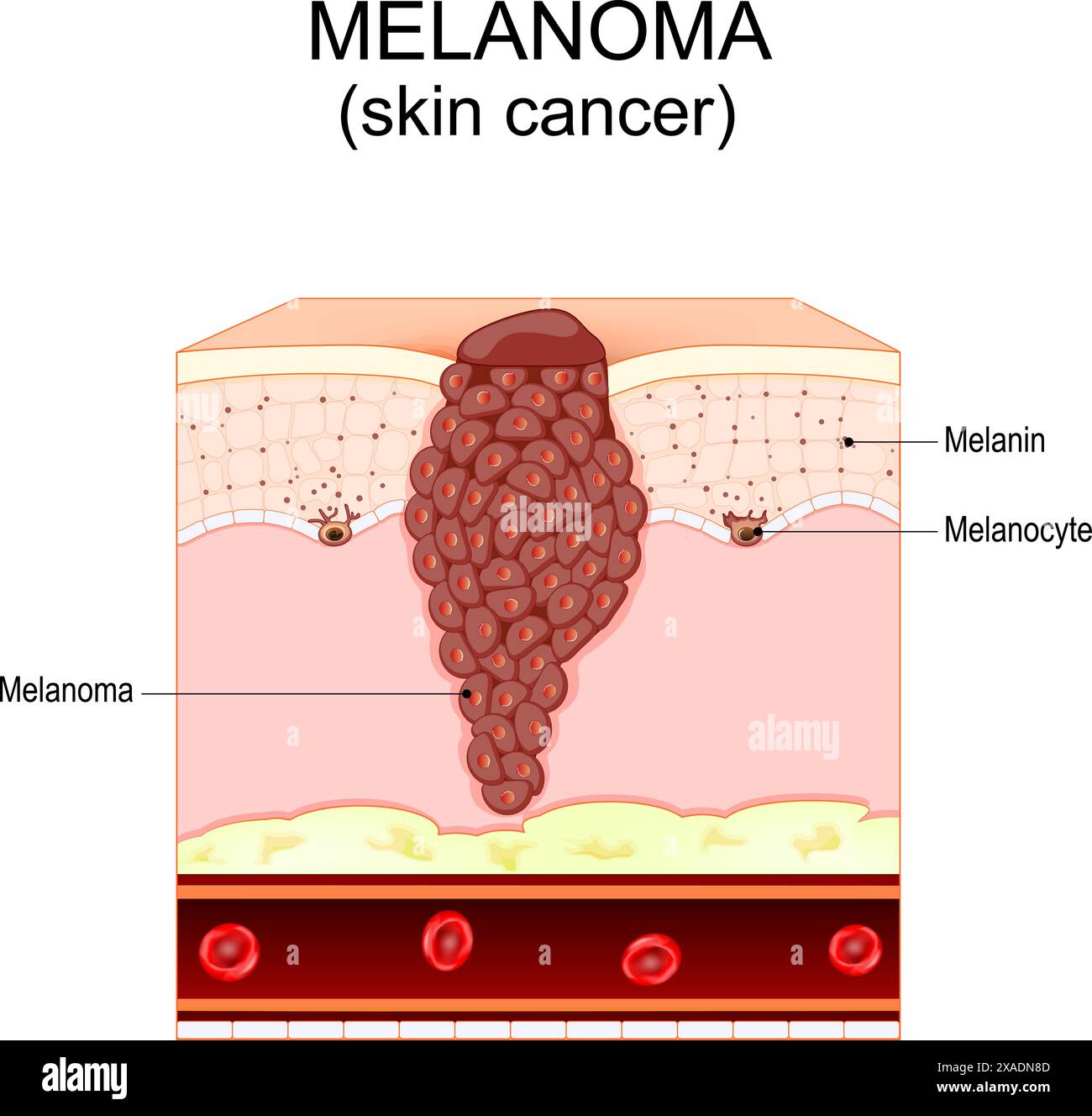 Melanom. Hautkrebs, der aus Melanozyten stammt. Schichten und Struktur der menschlichen Haut. Querschnitt der Haut. Vektorabbildung Stock Vektor