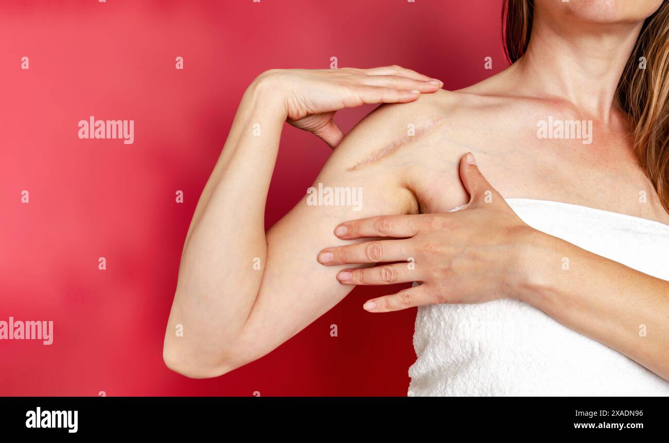 Postoperative Narbe auf der Schulter einer Frau. Eine Frau zeigt die Narbe. Narbe nach Operation nach gebrochenem Armknochen. Stockfoto