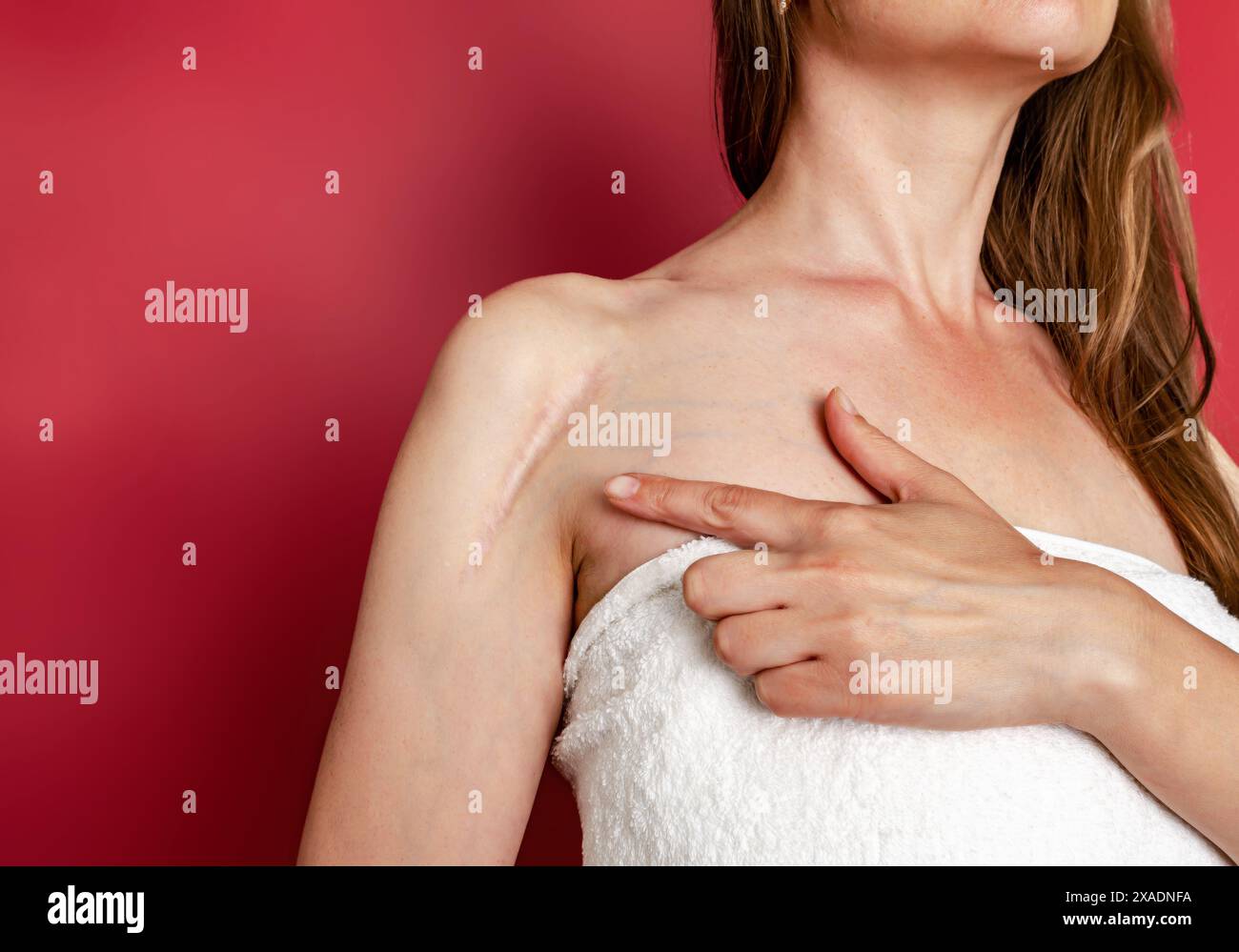 Postoperative Narbe an der Schulter der Frau. Eine Frau zeigt die Narbe. Narbe nach Operation nach gebrochenem Armknochen. Stockfoto