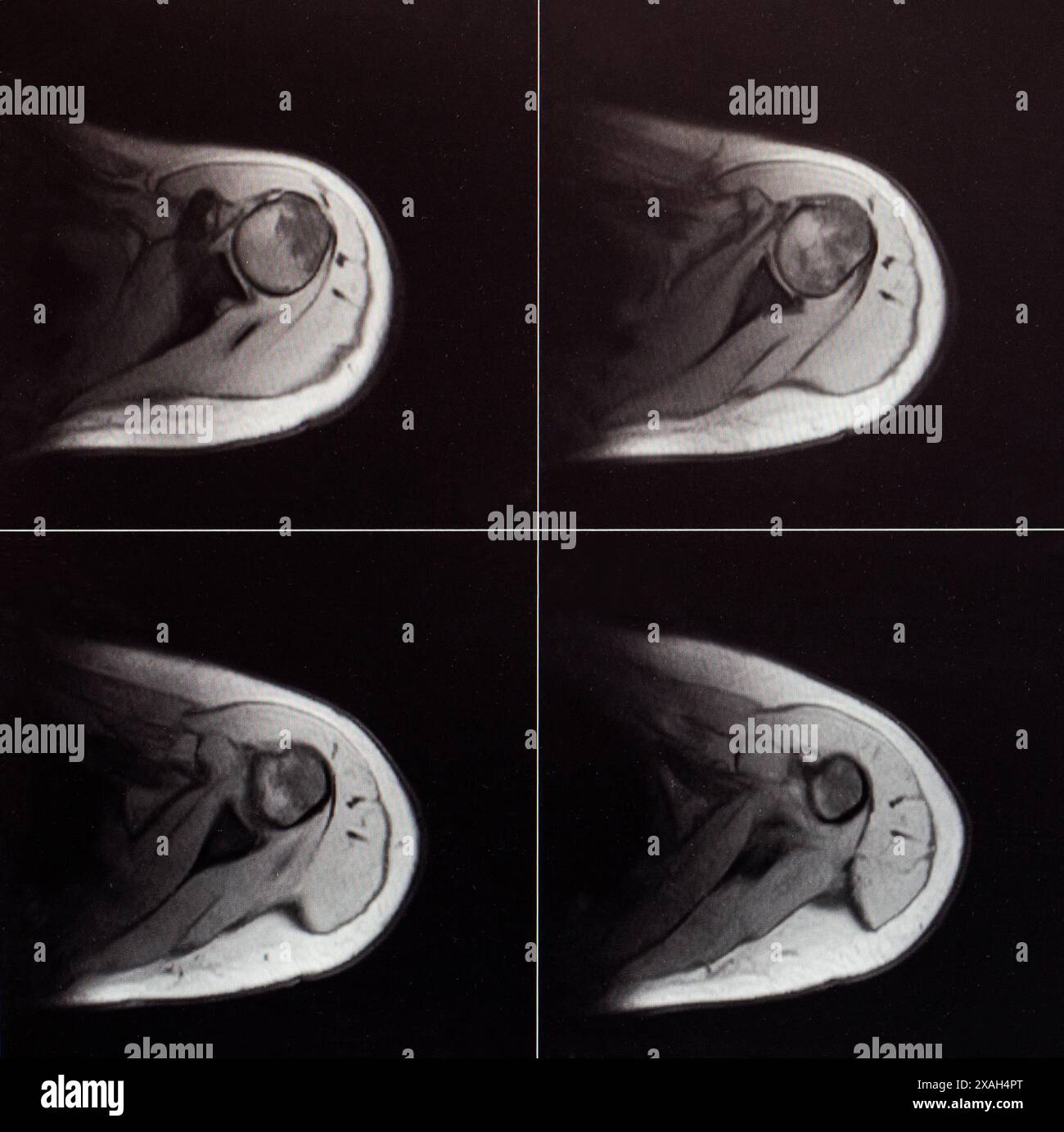MRT-Bild des Schultergelenkes nach Luxation. Die Abdruckfraktur des Humeruskopfes. Schulterverletzung Stockfoto