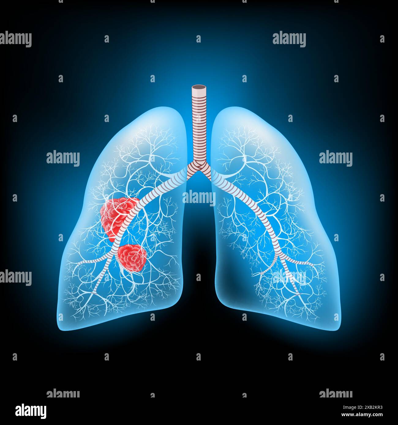 Lungenkrebs. Realistisch transparente blaue menschliche Lunge mit Tumor oder Metastasierung. Leuchtender Effekt auf dunklem Hintergrund. Vektorillustration wie Röntgenbild Stock Vektor