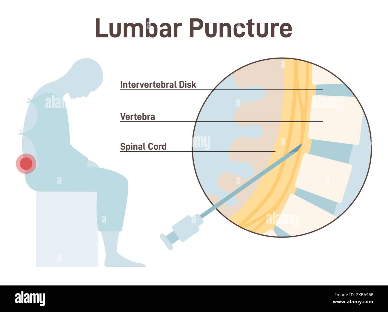 Lumbalpunktion. Spinalklopfen, Nadeleinführung in den Raum zwischen zwei Wirbeln, um eine Probe von Liquor zu entfernen. Neurologische und körperliche Krankheitsdiagnostik. Illustration des flachen Vektors Stock Vektor