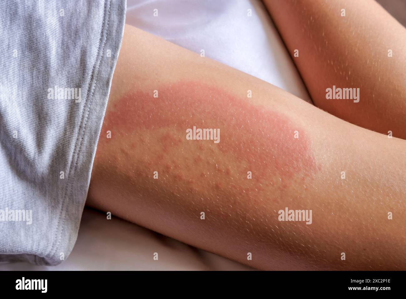 Ein Hautausschlag am Bein eines Kindes Stockfoto