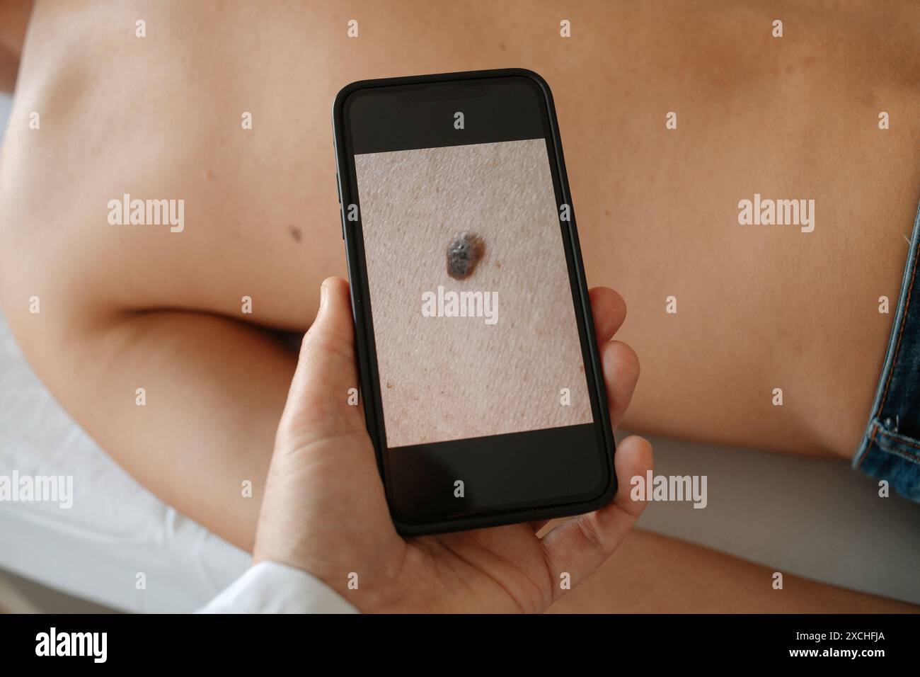 Ein Arzt macht Fotos von einem Maulwurf auf dem Rücken eines Patienten, der mit dem Gesicht nach unten auf dem Untersuchungstisch liegt Stockfoto