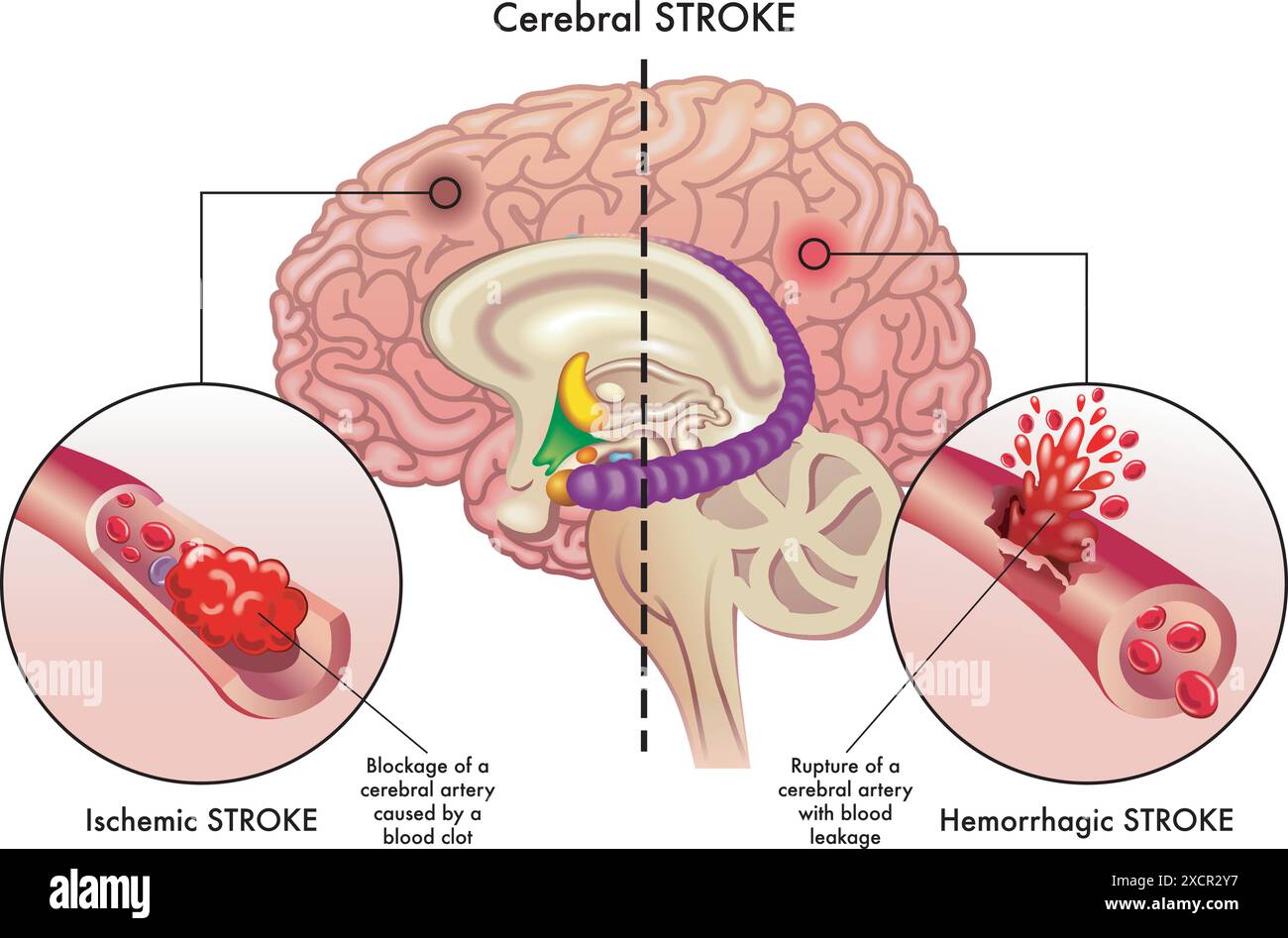 Die medizinische Illustration vergleicht die Ursachen von zwei Arten von Schlaganfall, einem ischämischen Schlaganfall und einem hämorrhagischen Schlaganfall, die die zerebrale arte beeinflussen Stock Vektor