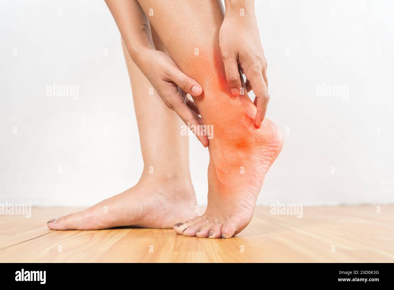 Eine Frau mit rotem Fuß hält ihr Bein. Das Konzept von Unwohlsein und Schmerz Stockfoto