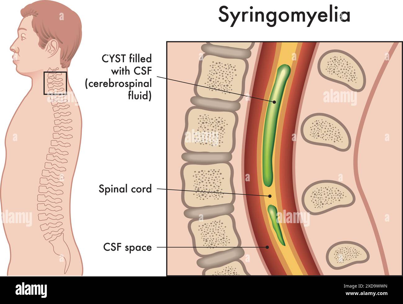 Medizinische Illustration zeigt die Symptome der Syringomyelie, einer Pathologie, die die Wirbelsäule betrifft. Stock Vektor