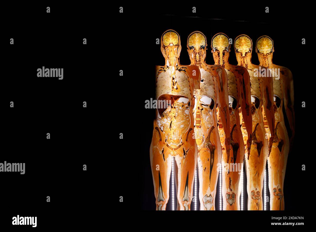 Impression aus der Anatomie-Ausstellung KÖRPERWELTEN & der Zyklus des Lebens von Wissenschaftler Dr. Gunther von Hagens und Kuratorin Dr. Angelina Whalley in der Oskar-Jäger-Straße 99. Achtung: Zugelassen für rein redaktionelle Nutzung. Keine Nutzung der Bilder als Buchillustrationen, Werbemaßnahmen oder in anderen nicht-journalistischen Formaten Köln, 21.06.2024 NRW Deutschland *** Eindruck aus der Anatomieausstellung KÖRPERWELTEN der Zyklus des Lebens von Wissenschaftlerin Dr. Gunther von Hagens und Kuratorin Dr. Angelina Whalley in der Oskar Jäger Straße 99 Aufmerksamkeit nur zur redaktionellen Verwendung zugelassen keine Verwendung o Stockfoto