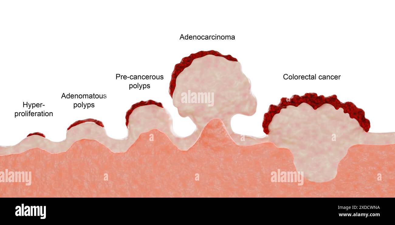 Darstellung der Stadien der kolorektalen Tumorentwicklung. Hyperproliferation, adenomatöse Polypen und präkanzeröse Polypen sind abnorme Zellwucherungen in der Darmschleimhaut oder im Rektum, die normalerweise gutartig sind. Bleiben diese Wucherungen jedoch unbehandelt, besteht die Möglichkeit, dass sie bösartig werden und sich zu Darmkrebs entwickeln können. Adenokarzinom und kolorektales Karzinom beschreiben maligne Stadien dieses Wachstums. Polypen können chirurgisch entfernt werden, um zu verhindern, dass sie sich zu Krebs entwickeln. Stockfoto