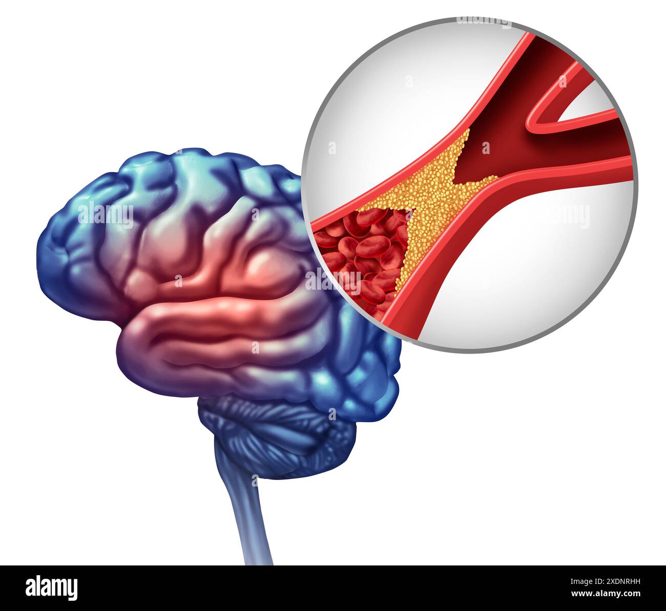 Hirninfarkt als Blutfluss im Gehirn vollständig blockiert in einer Arterie durch Plaque oder Blutgerinnselbildung wie Atherosklerose oder Emboli. Stockfoto