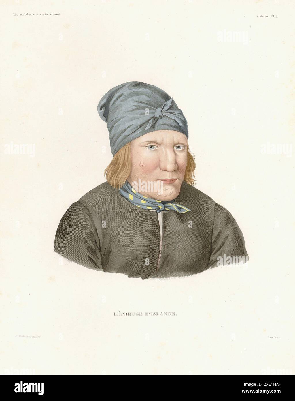 Frau mit Lepra. Buch 'Voyage en Islande et au Groënland' von Louis-Eugène Robert. Illustriert von Antoine Maurin und veröffentlicht 1835–1836. Kredit:Photo12 Stockfoto