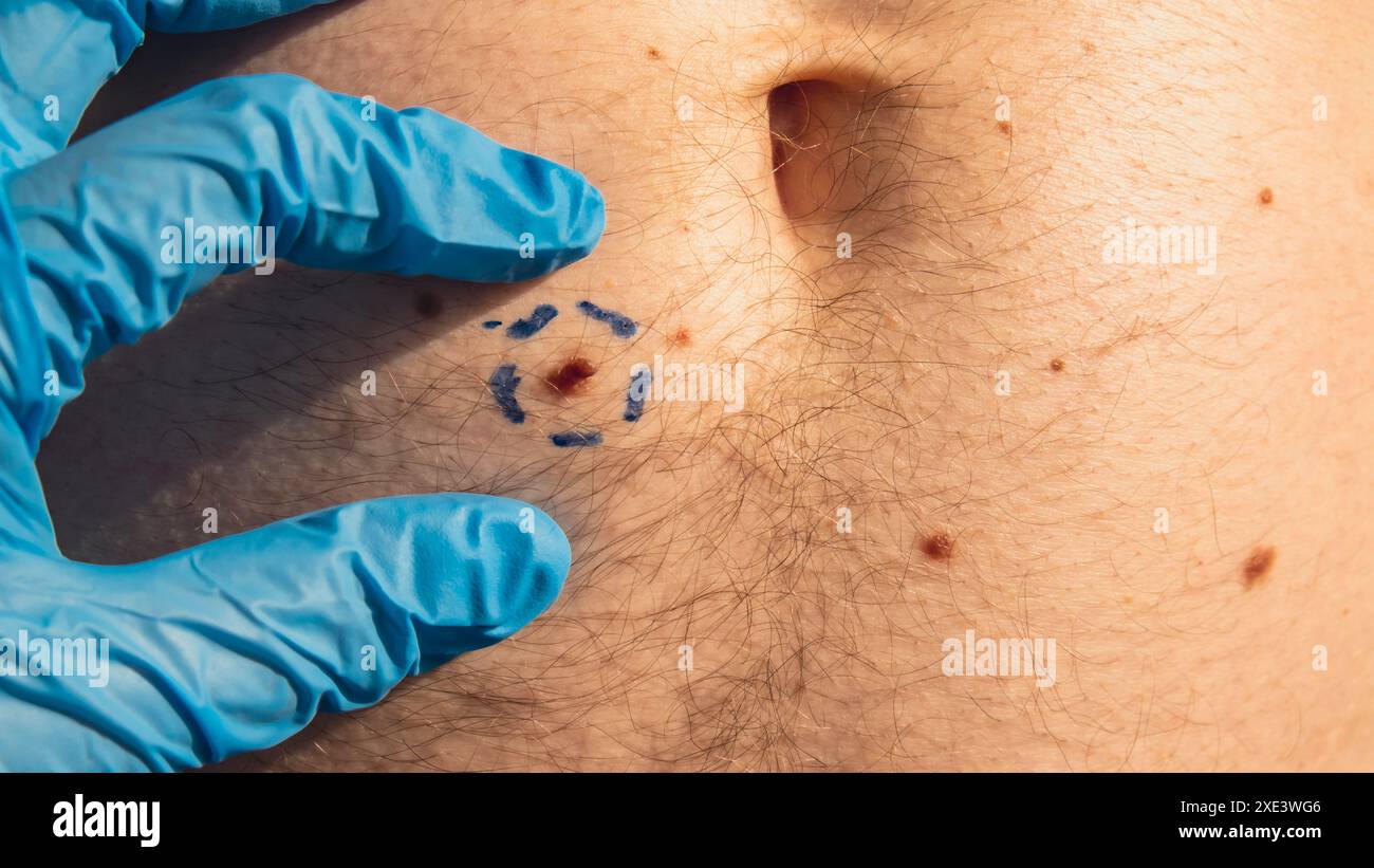 Arzt in medizinischen Handschuhen malen Linien um männliche Muttermale. Vorbereitung des chirurgischen Eingriffs. Entfernen von Laserhautmarkierungen. P Stockfoto