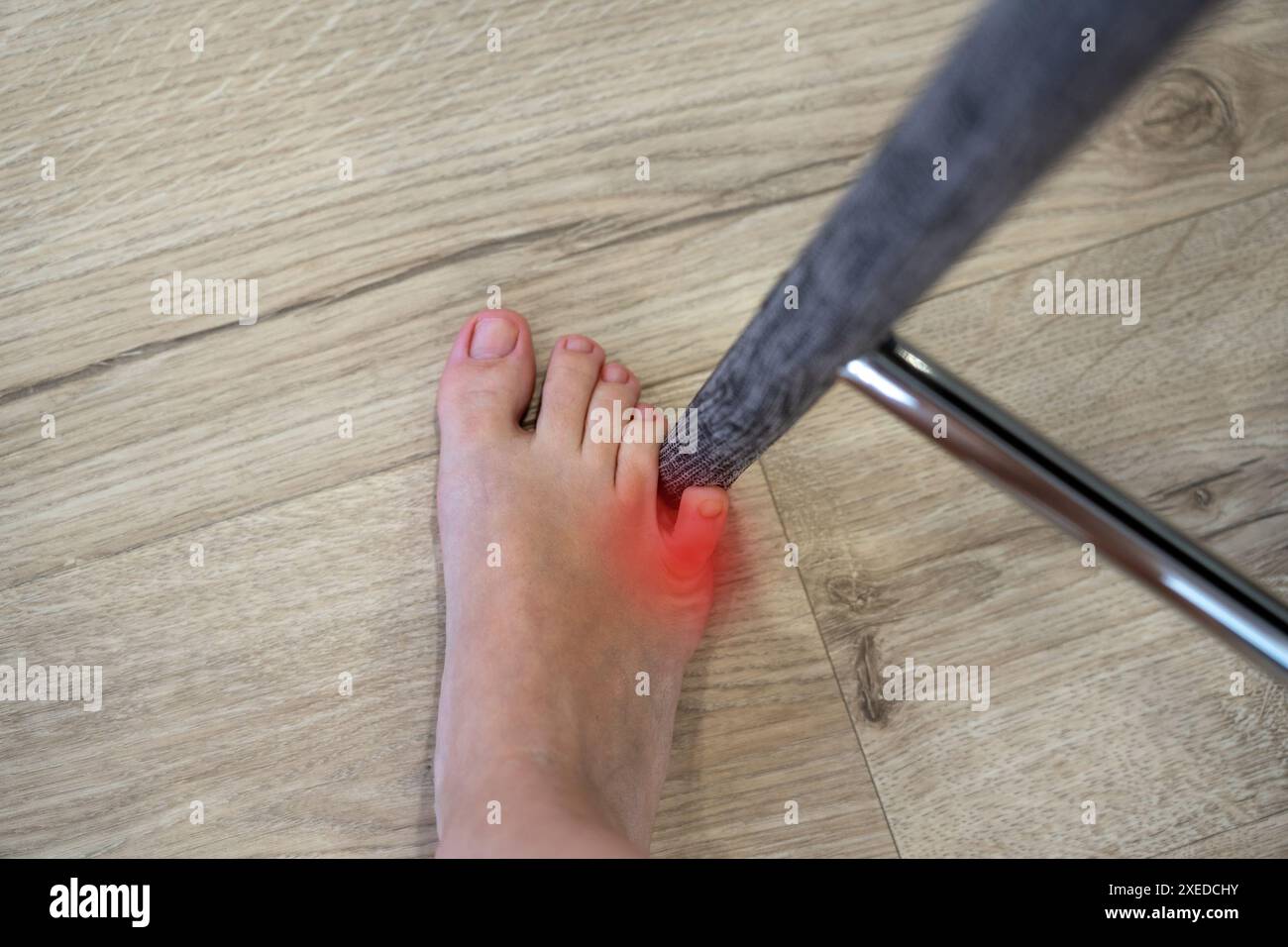 Frau schlug mit dem kleinen Zeh auf den Stuhl. Vorfall zu Hause. Roter Fleck mit Verletzung eines kleinen Fußfingers Stockfoto