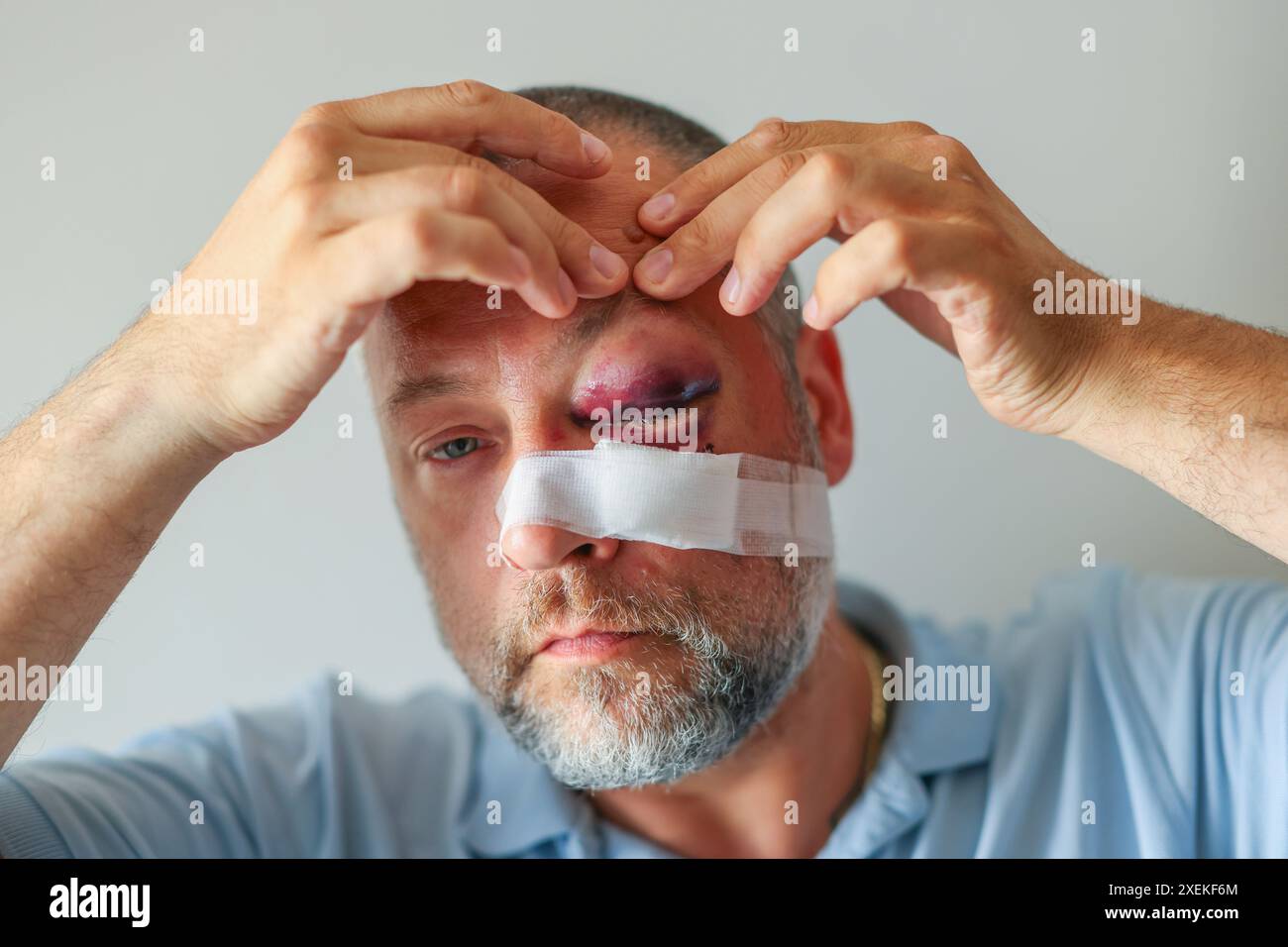 Nahaufnahme von einem weißen Mann mit einem Lila schwarz Auge und Kopf Verletzung - Auge geschlossen Stockfoto