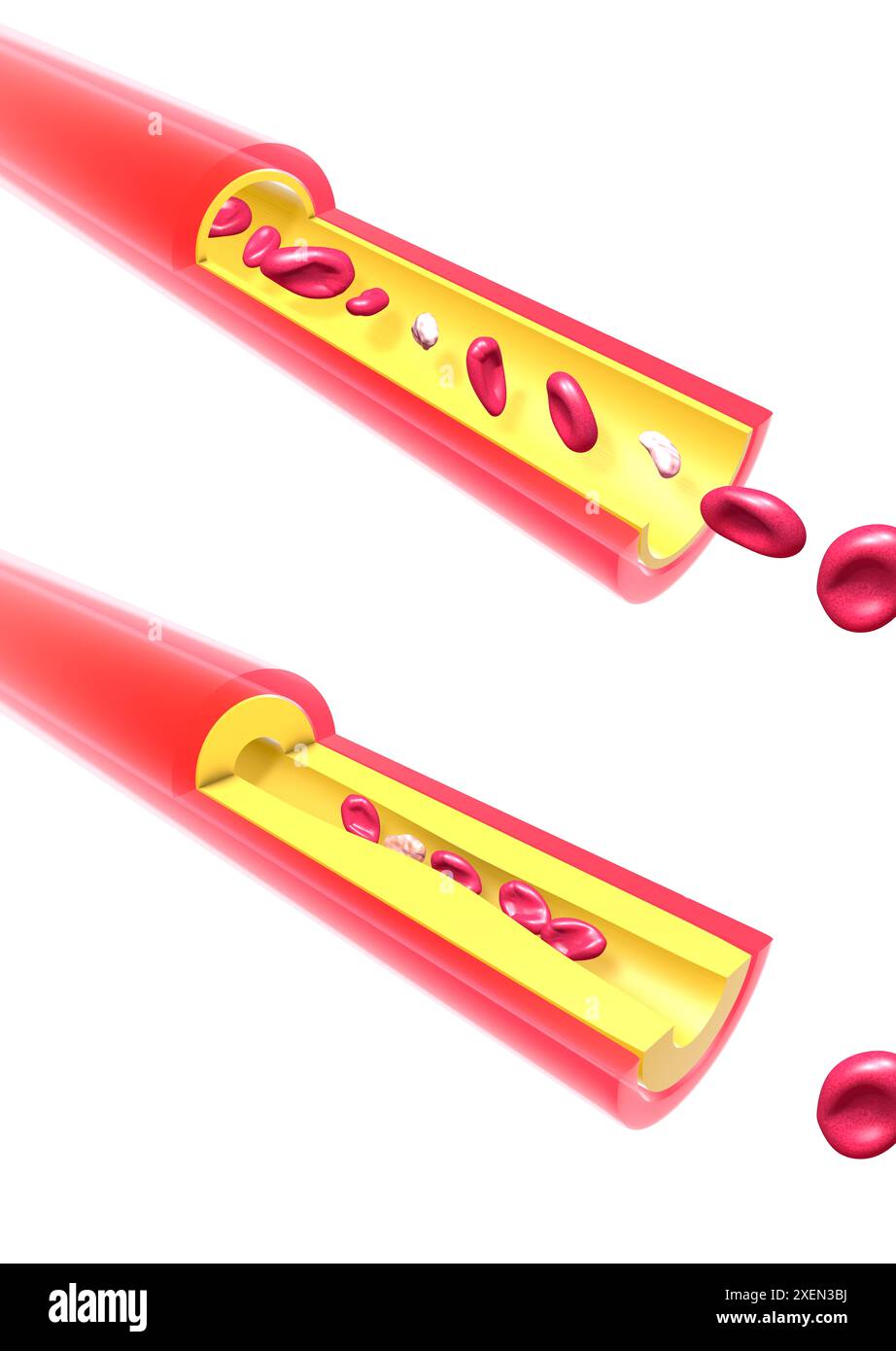 Anatomische 3D-Darstellung einer Arterie, die durch angesammeltes Fett blockiert wird. Verlangsamt rote Blutkörperchen und Blutplättchen im Blutkreislauf. Stockfoto