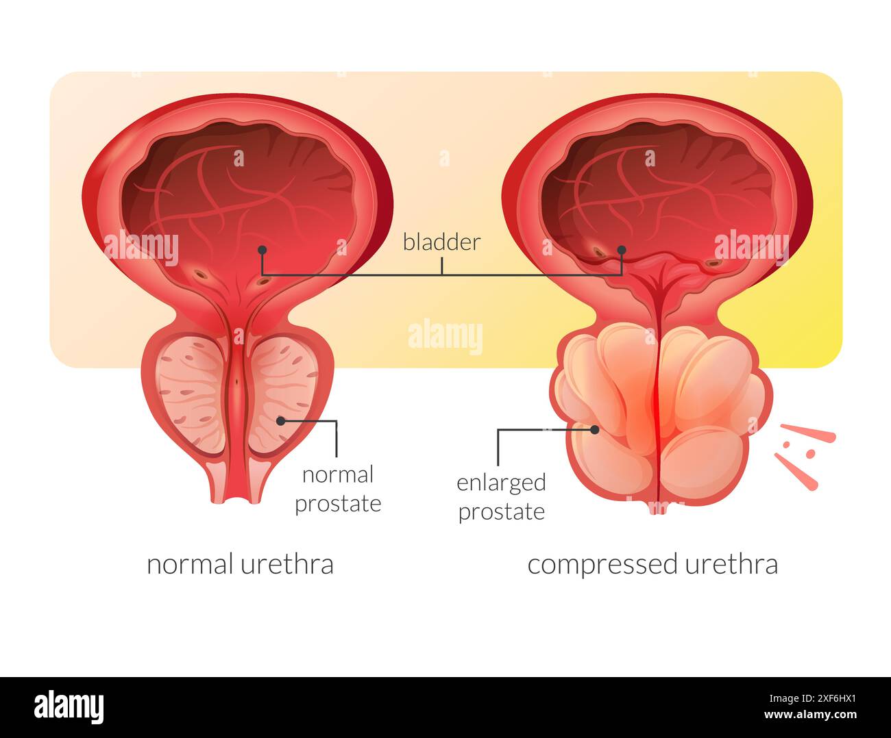 Normale Prostata und vergrößerte Prostatadrüse unter der Blase – Stock-Illustration als EPS 10-Datei Stock Vektor