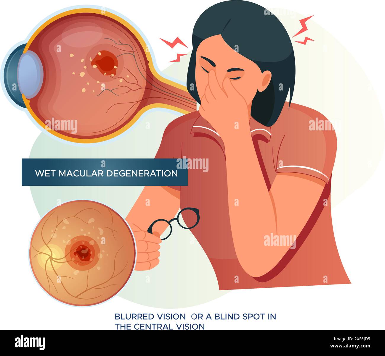 Feuchte Makuladegeneration – verschwommenes Sehen – Stock-Illustration als EPS 10-Datei Stock Vektor