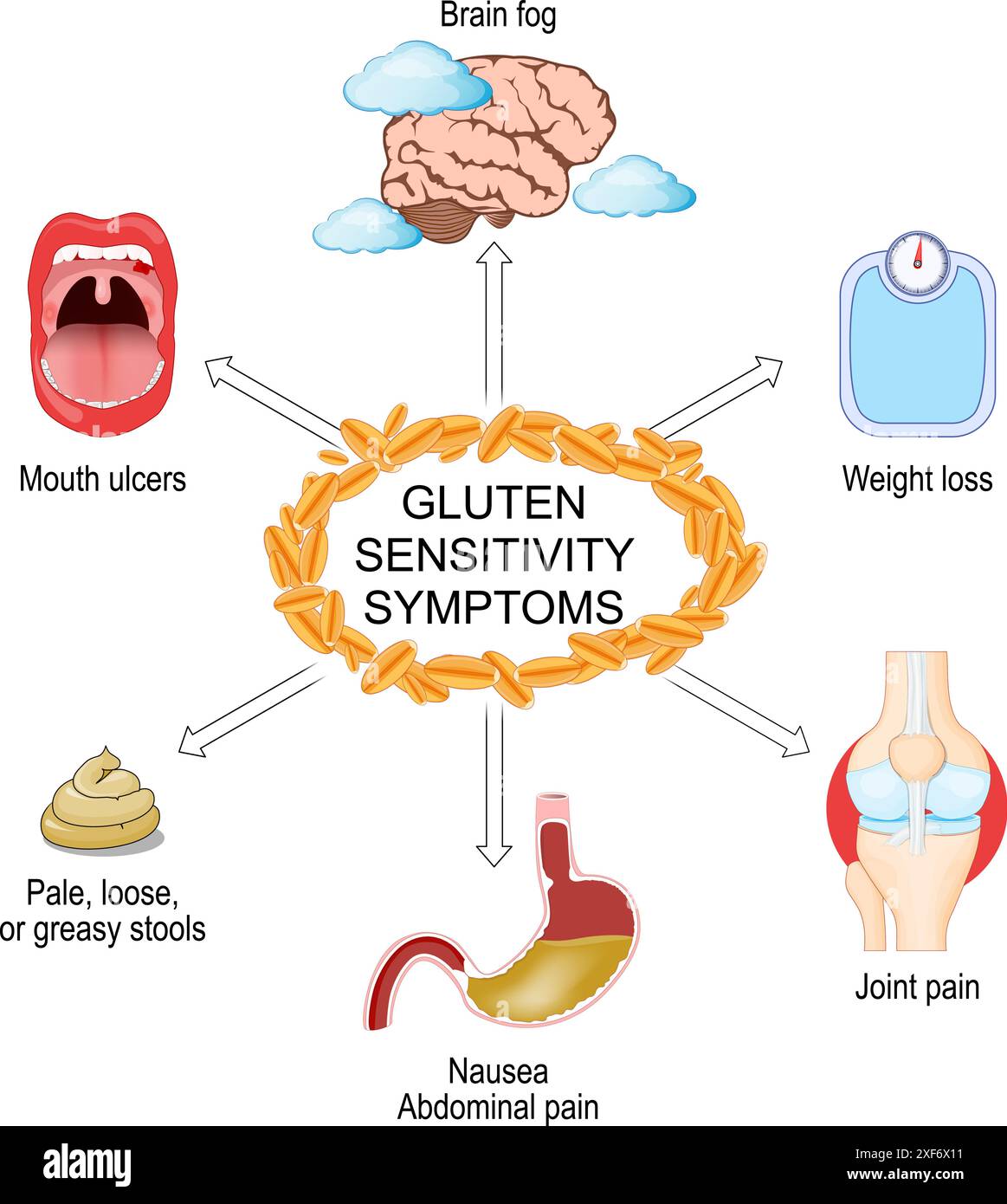 Glutenempfindlichkeitssymptome. Gluten-Intoleranz. Zöliakie. Infografiken. Vektorabbildung Stock Vektor