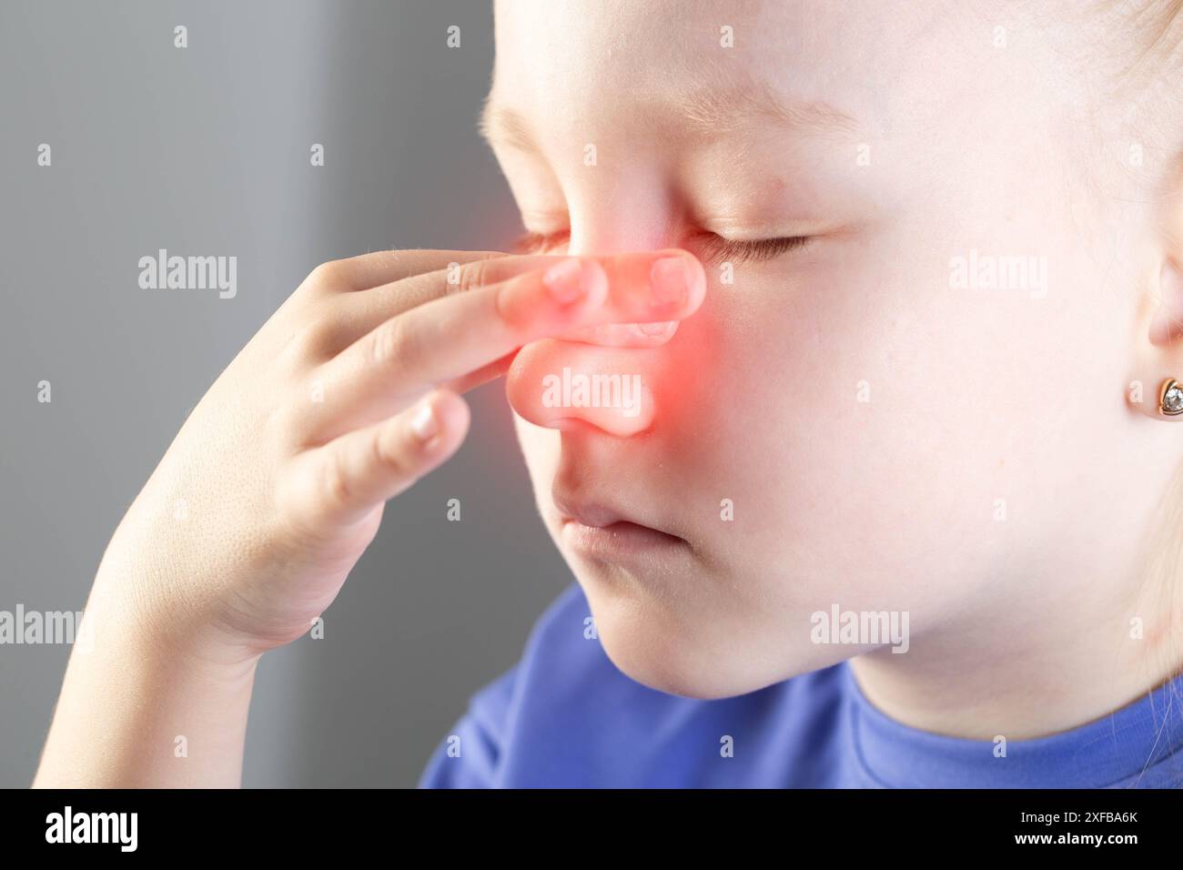 Ein Mädchen hält ihre rote Nase, deren Haut aufgrund einer laufenden Nase gereizt ist. Schmerzen in den Kieferhöhlen, laufende Nase, Nasenseptum Stockfoto