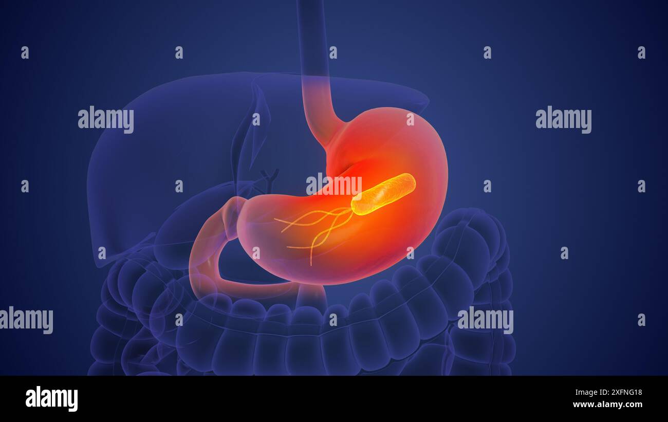 Helicobacter pylori im menschlichen Magen Stockfoto